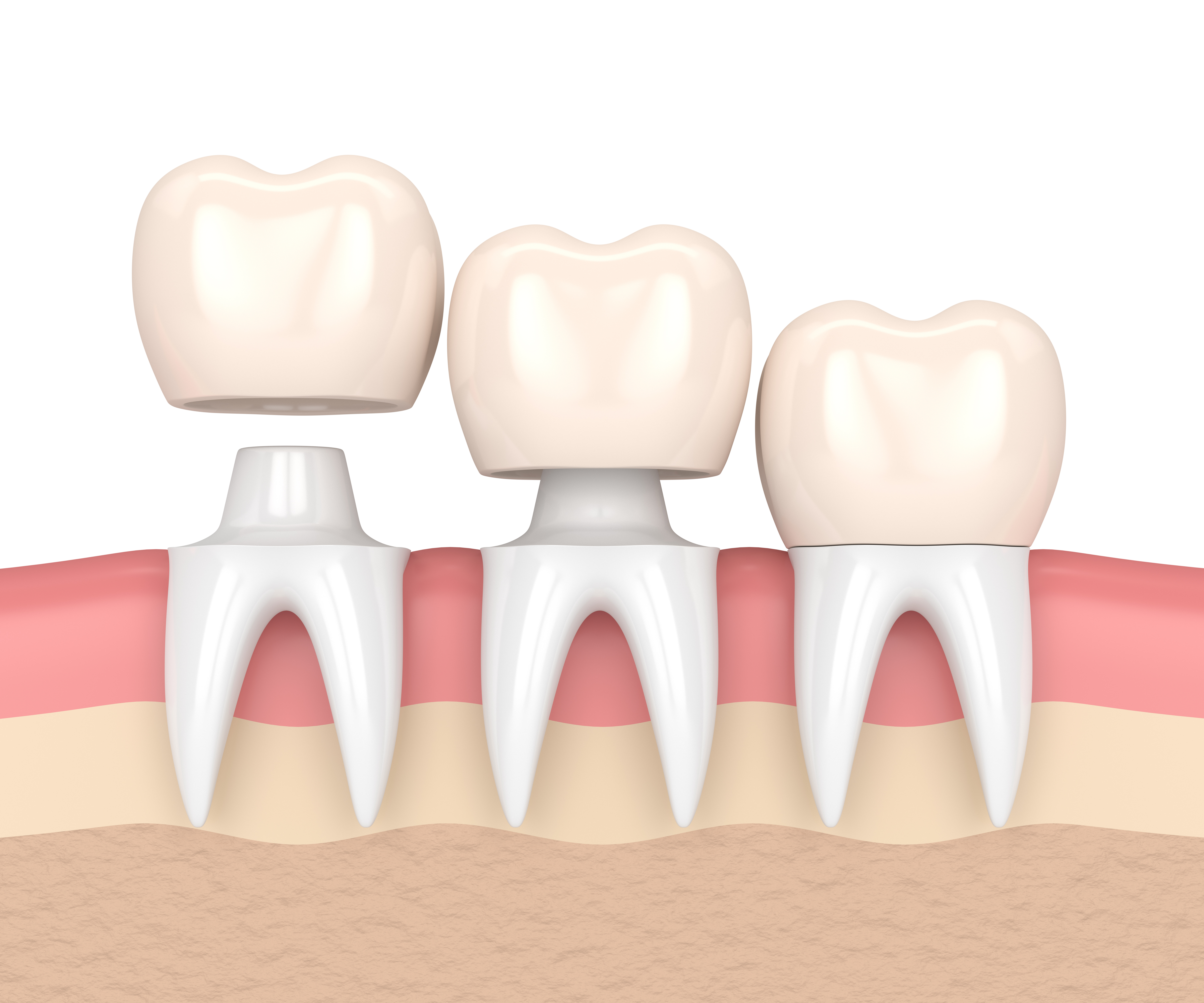 north salt lake dental crowns Dr. Will Bates. Serene Dentistry of North Salt Lake. General, Cosmetic, Restorative, Pediatric Family Dentistry Dentist in Salt Lake City UT 84054