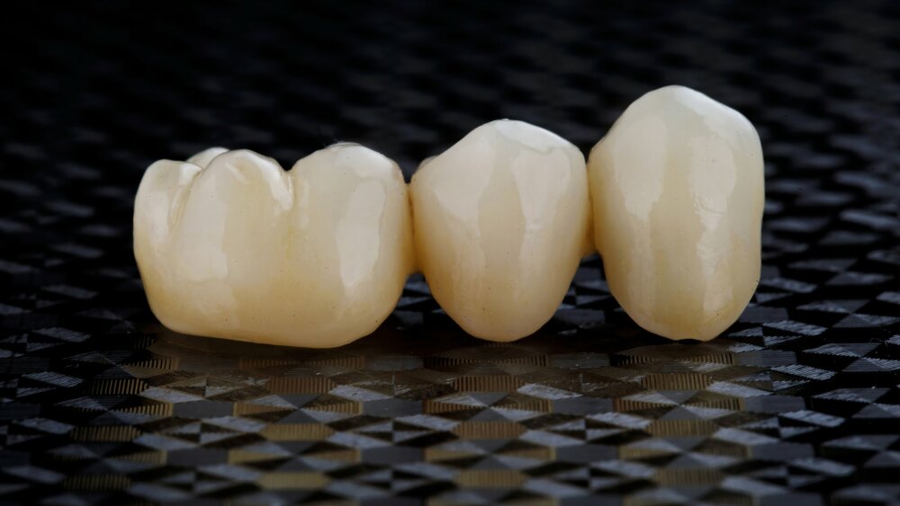 dental bridges north salt lake